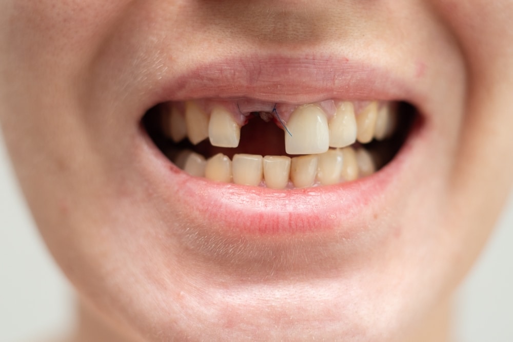 brushing teeth after extraction